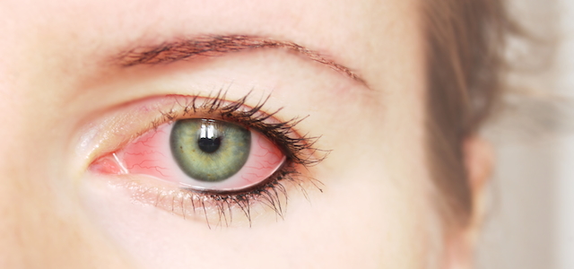 condition-pink-eye