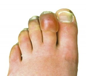 Frostbite on Toes