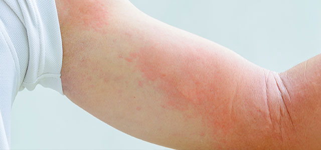 condition-hives-urticaria