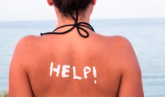 blog-sunburn-help